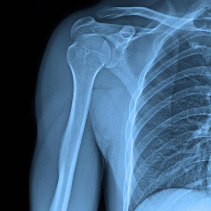 X-ray of shoulder joint